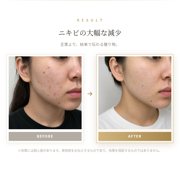多機能ダーマペン S-LAB Derma｜マイクロニードリング エレクトロポレーション EMS 4役 ニキビ跡 毛穴 小ジワ 美肌 コラーゲン 肌再生 美容家電 自宅エステ クリニック級 30代 誕生日プレゼント 彼女 妻 記念日 クリスマス ギフト 結婚記念日 サプライズ 喜ばれる 女性へ 20代 30代 40代 贈り物 高級 プチ贅沢 特別な日 もらって嬉しい